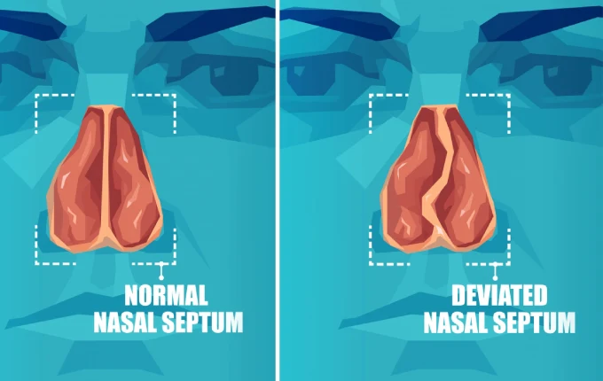 Vector cross section of face with deviated and normal nasal septum