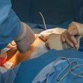 Breast Surgery Negligence