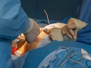 Breast Surgery Negligence